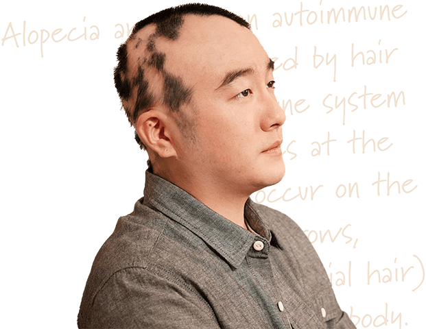 adult man with alopecia areata on scalp