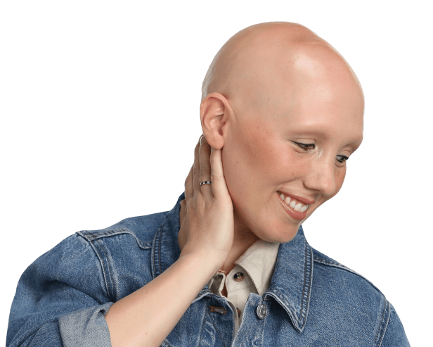 woman with alopecia areata on scalp