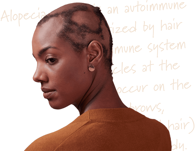 woman with alopecia areata on scalp