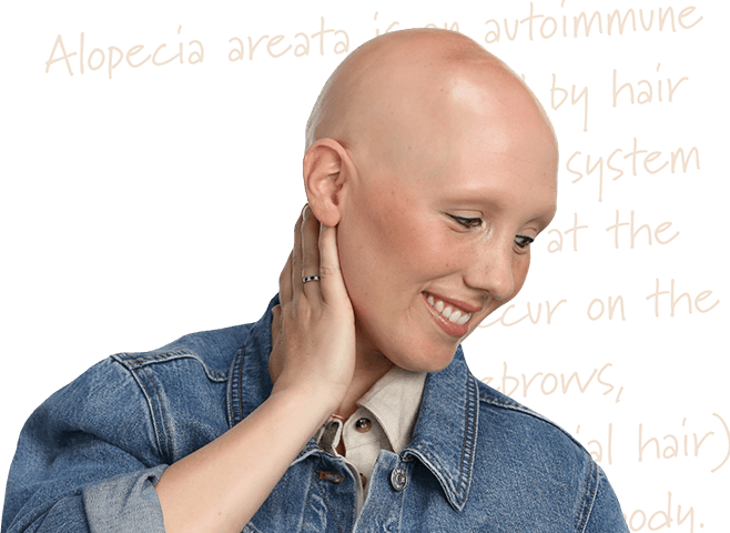 woman with alopecia areata on scalp