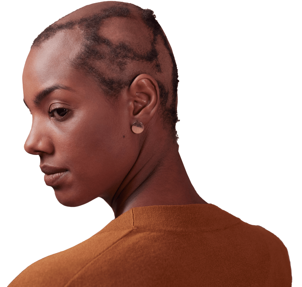 woman with alopecia areata on scalp